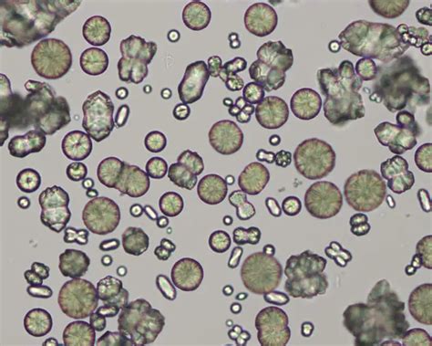 Types of Crystals Found In Human Urine and Their Clinical Significance - Laboratoryinfo.com