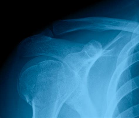 Can You Speed the Healing of a Collarbone Fracture? | STACK