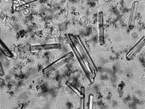 Investigation into Struvite Crystal from Anabolic Steroids in Human ...