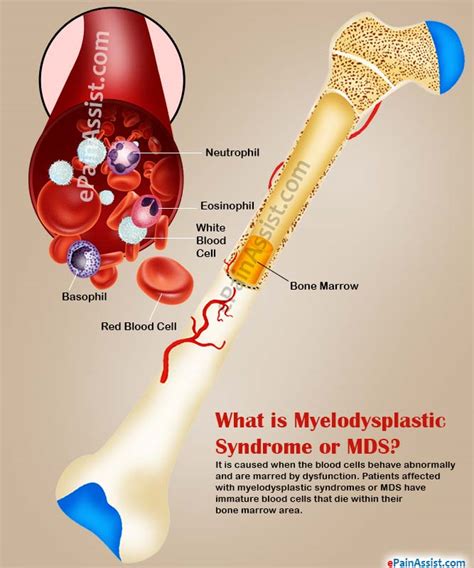 What is Myelodysplastic Syndrome|Causes|Types|Signs|Symptoms