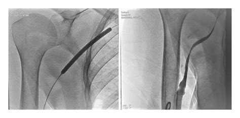 Central vein stenosis and balloon fistuloplasty. | Download Scientific Diagram