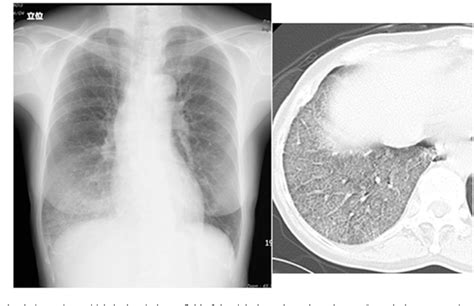 Figure 2 from A case of lipoid pneumonia caused by inhalation of ...