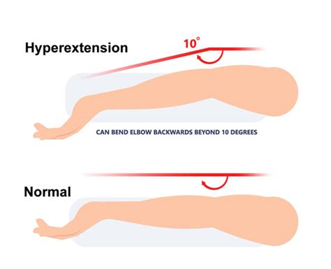 Hyperextension Arm