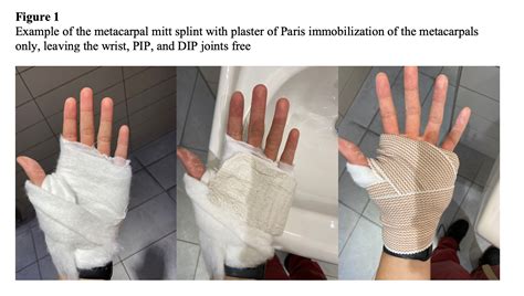 Pip Joint Fracture Splint | edu.svet.gob.gt