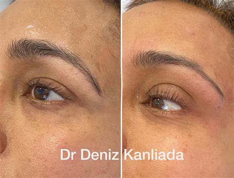 Eye Brow Lift and Cat Eye, Fox Eye Lift | Dr Deniz Kanliada