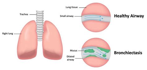 Suppurative Lung Disease Including Bronchiectasis - Dr. Ankit Parakh