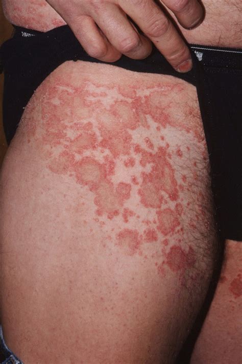 Pityriasis Rosea - Causes, Rash, Herald Patch, Stages, Treatment