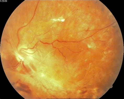 Severe Proliferative Diabetic Retinopathy - Retina Image Bank