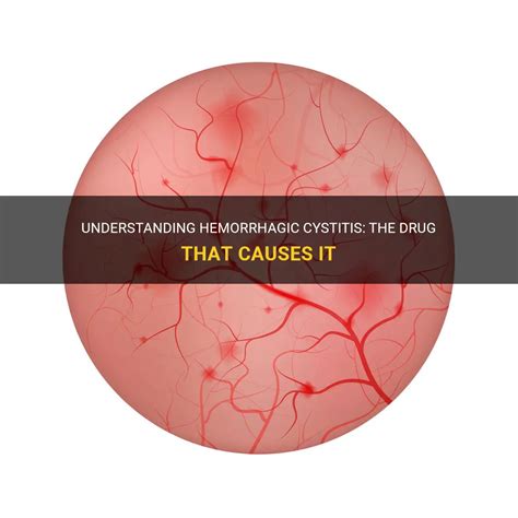 Understanding Hemorrhagic Cystitis: The Drug That Causes It | MedShun