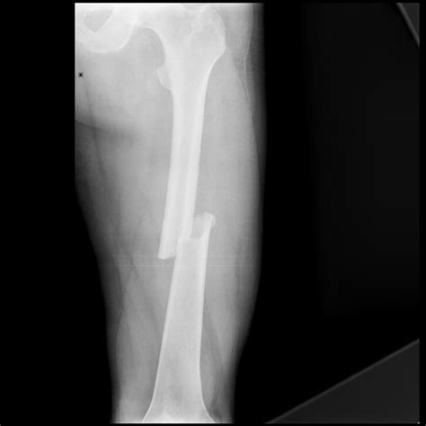 Femoral Shaft Fractures – Core EM