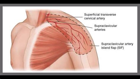 SUPRACLAVICULAR FLAP - YouTube