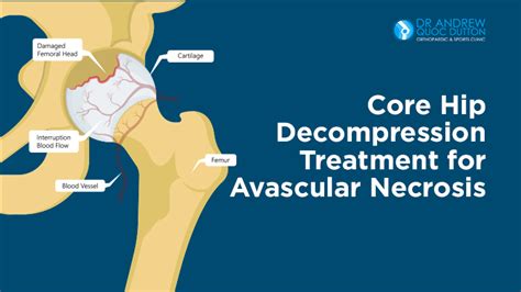 Core Hip Decompression Treatment for Avascular Necrosis | A/Professor Andrew Dutton