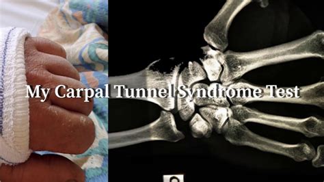 Carpal Tunnel Electromyogram test cts of the median nerve - YouTube