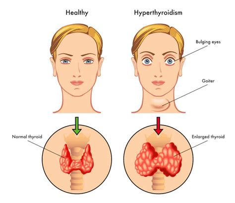 Diagnosis & Treatment for Hyperthyroidism Problem | Livofy