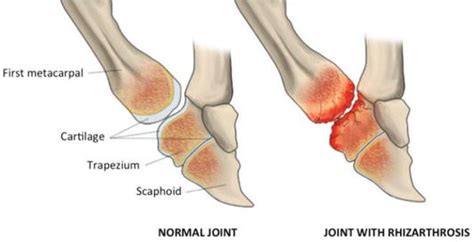 Trapeziometacarpal Joint: A Mechanical Explanation of Total Prosthesis Failures | IntechOpen