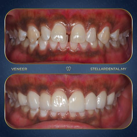 Everything You Need to Know About Teeth Veneers - Stellar Dental