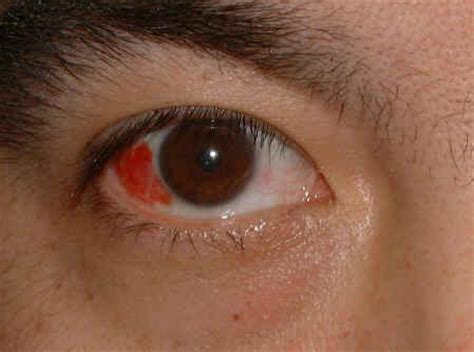 Subconjunctival Hemorrhage Causes, Symptoms, Diagnosis and Treatment ...