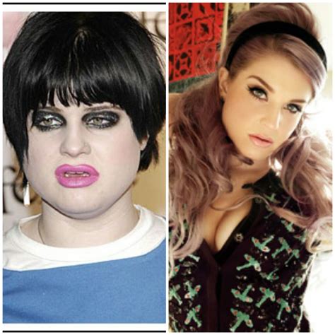 Kelly Osbourne Before And After Plastic Surgery