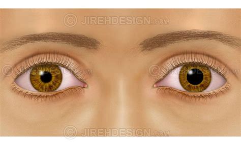 Anisocoria eye condition medical eye illustration - #CO0053