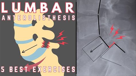 Best Exercises for Lumbar Anterolisthesis | Relieve Lower Back Pain ...