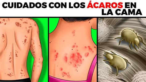 ÁCAROS EN LA CAMA: alergias, peligros, cómo se mira en tu piel, cómo eliminarlos y prevenirlos ...