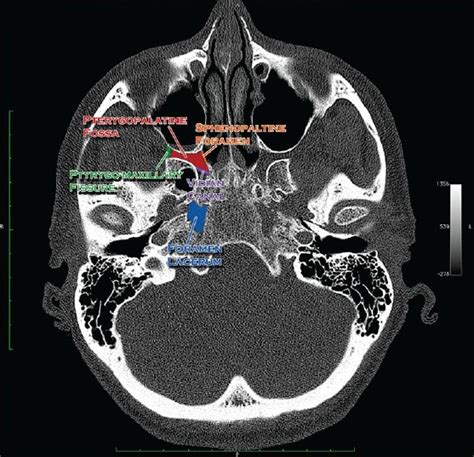 Clinical functional anatomy of the pterygopalatine ganglion, cephalgia ...