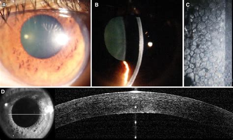 a, b One month follow-up- complete resolution of corneal edema; c... | Download Scientific Diagram