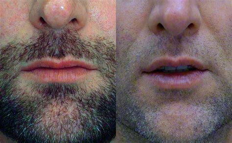 Before & After Male lip lift - 2 mm of skin removal | Ricardo L. Rodriguez MD, Baltimore Plastic ...