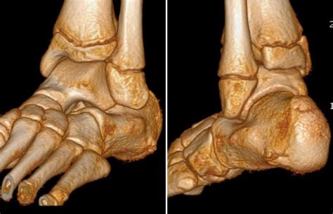 Fibulocalcaneal Impingement in a Growing Child With Otherwise ...