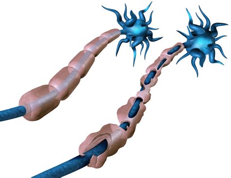 Different Kinds of Spasticity in Multiple Sclerosis » Scary Symptoms