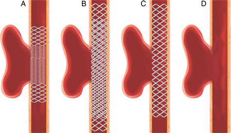 Compaction of flow diverters improves occlusion of experimental wide ...