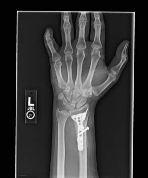 Wrist Fractures