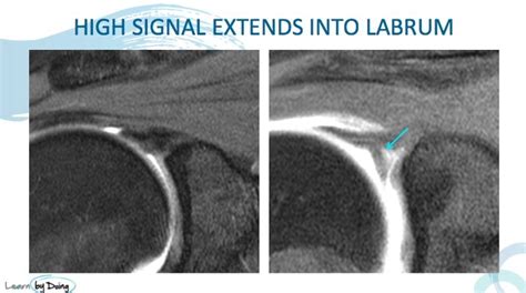 MRI Shoulder SLAP Tears 3 Things to look for | Radedasia