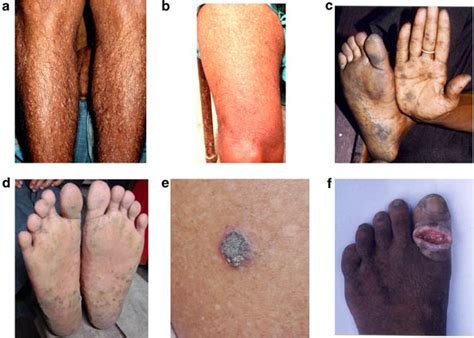 Arsenic Poisoning – Medchrome