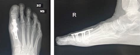 MTP Joint Fusion | Peter Rosenfeld FRCS, London