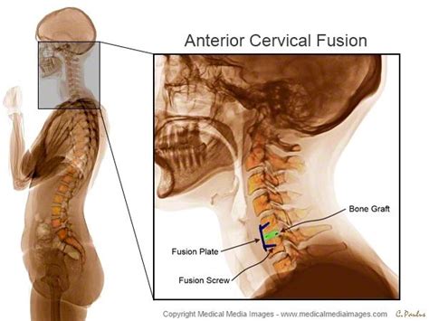 Pin on Anterior Cervical Fusion shown on Color X-Rays