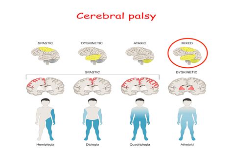 Mixed Cerebral Palsy | LegalFinders