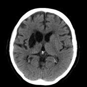 Basal Ganglia Encephalomalacia