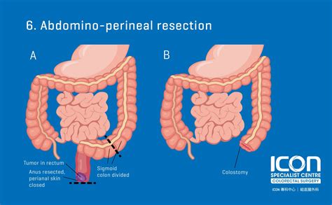 Colorectal resection (colectomy) — Icon Specialist Centre