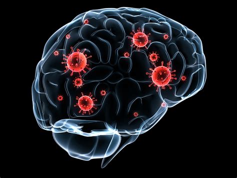 ¿Qué es la metástasis cerebral? - Gamma Knife