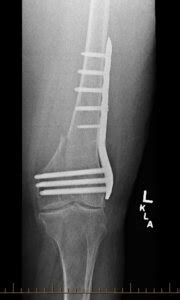 How Long is plate and screws in the femur removal recovery time? : r/brokenbones