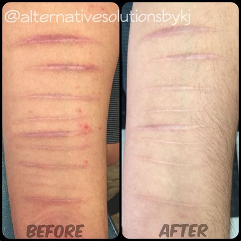 Skin needling-scar removal before & after by Krystin Jones Scar Tattoo, Get A Tattoo, Skin Color ...