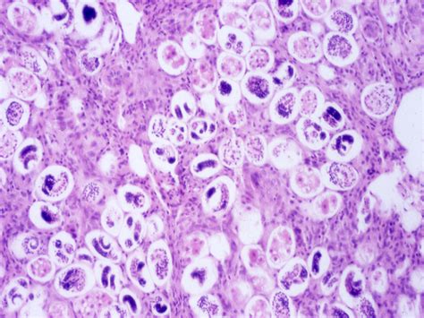 Angiostrongylus cantonensis and neuroangiostrongyliasis (rat lungworm ...