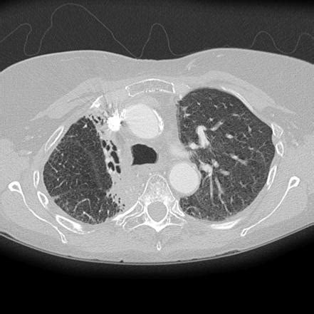 Traction bronchiectasis | Radiology Reference Article | Radiopaedia.org