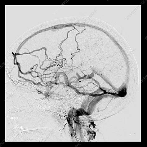 Carotid Cavernous Fistula Mri