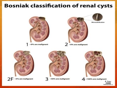 Bosniak Classification & Renal Cystic Disease