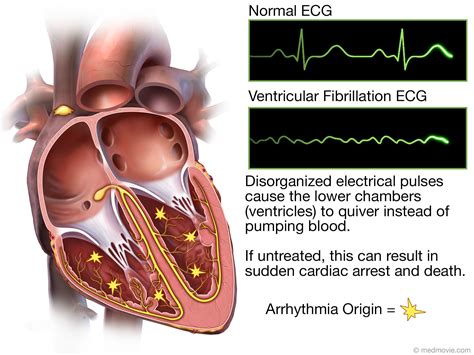 Medmovie.com | Ventricular Fibrillation