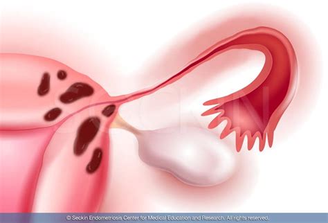 Adenomyosis - Symptoms, Causes, Diagnosis & Treatment