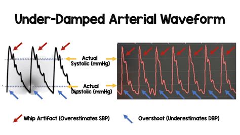 Overdamped Vs Underdamped Arterial Line