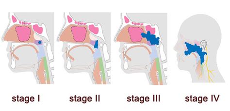 Nasopharyngeal Cancer Staging | Modern Cancer Hospital Guangzhou, China